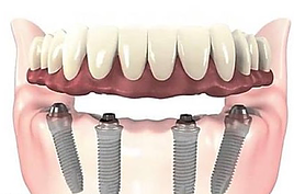 implantes-dentales-4