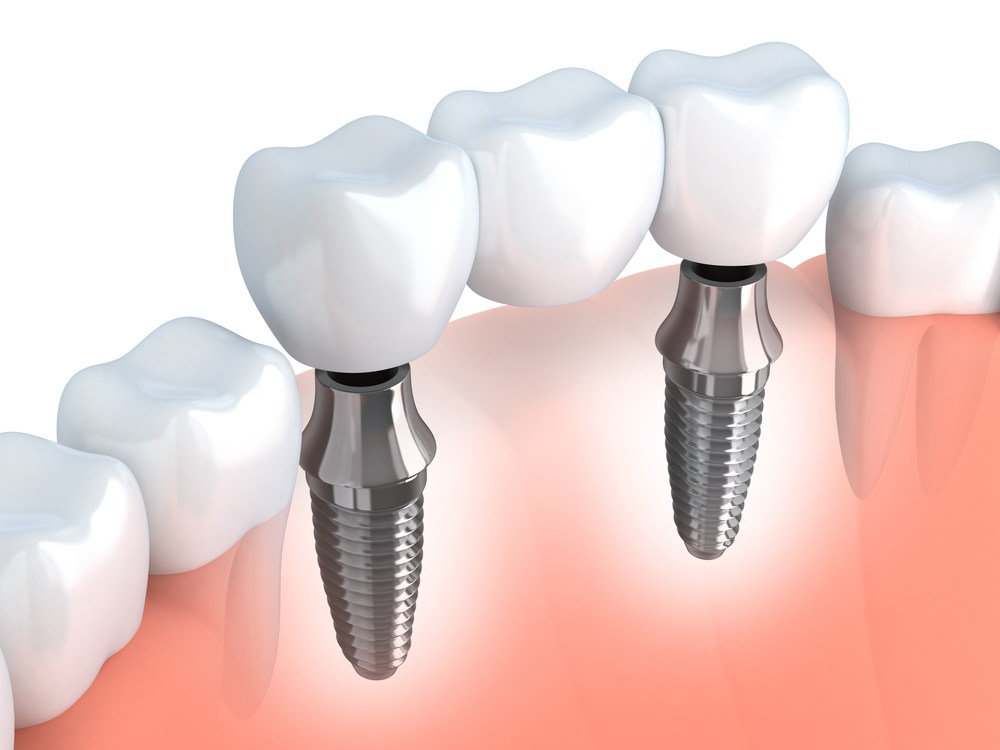 puente implantes