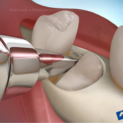 tercer molar2.png