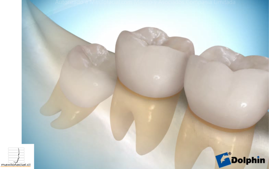 tercer molar1