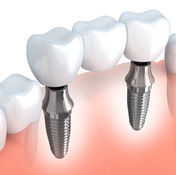 puente implantes.jpg