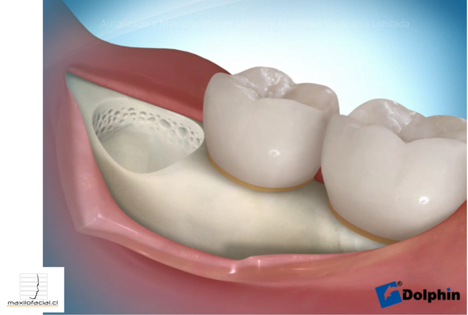 tercer molar3