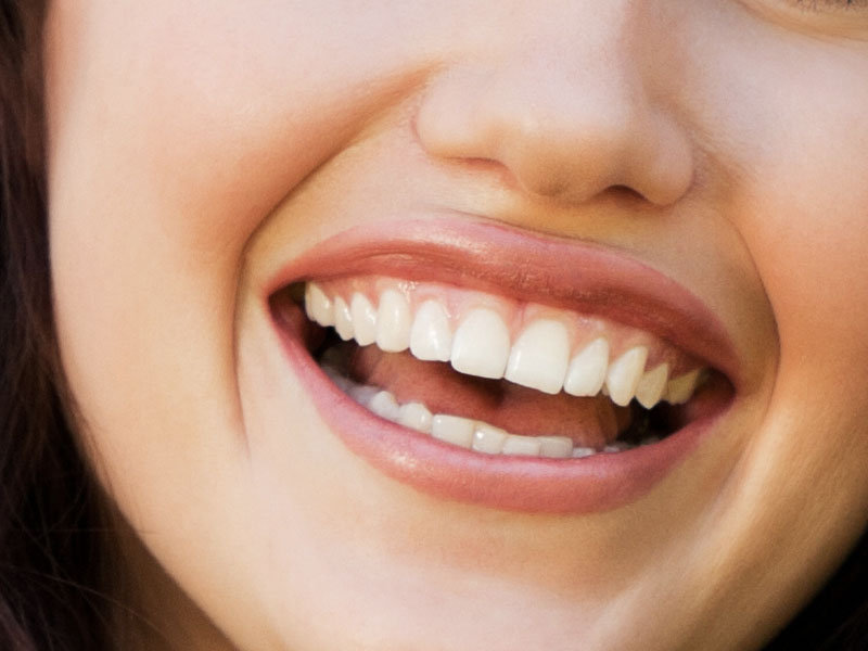 Diseño digital de sonrisas