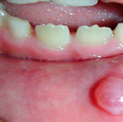 mucocele-en-el-labio.jpg