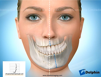 asimetria facial.png