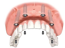 implantes-dentales-3