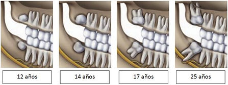 molar del juicio.jpg