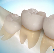 tercer molar1.png
